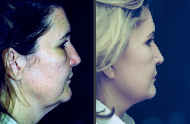 Facelift | Case 1 | Side View | Cosmetique Cosmetic Surgery Center before & after image of facelift treatment Miami FL