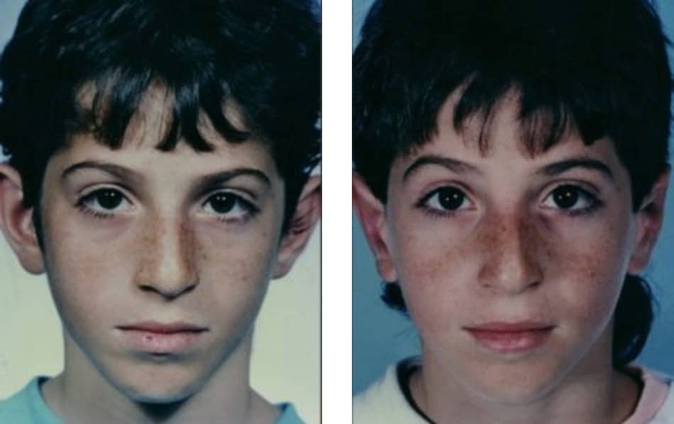 B&A Otoplasty before & after image of ear pinning Miami FL