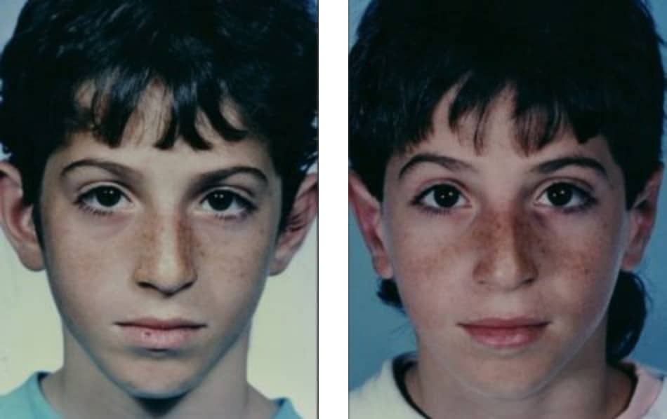 young boy before and after otoplasty ear pinning surgery, ears not sticking out after procedure