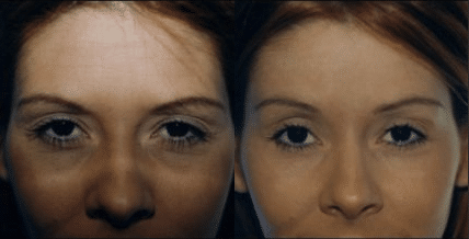 Screen-Shot-2018-10-11-at-11.53.44-AM before & after image of forehead lift Miami FL