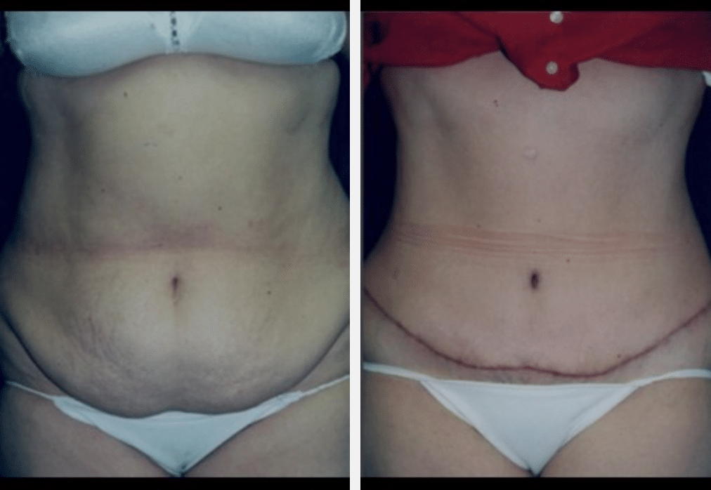 before & after image of tummy tuck miami FL