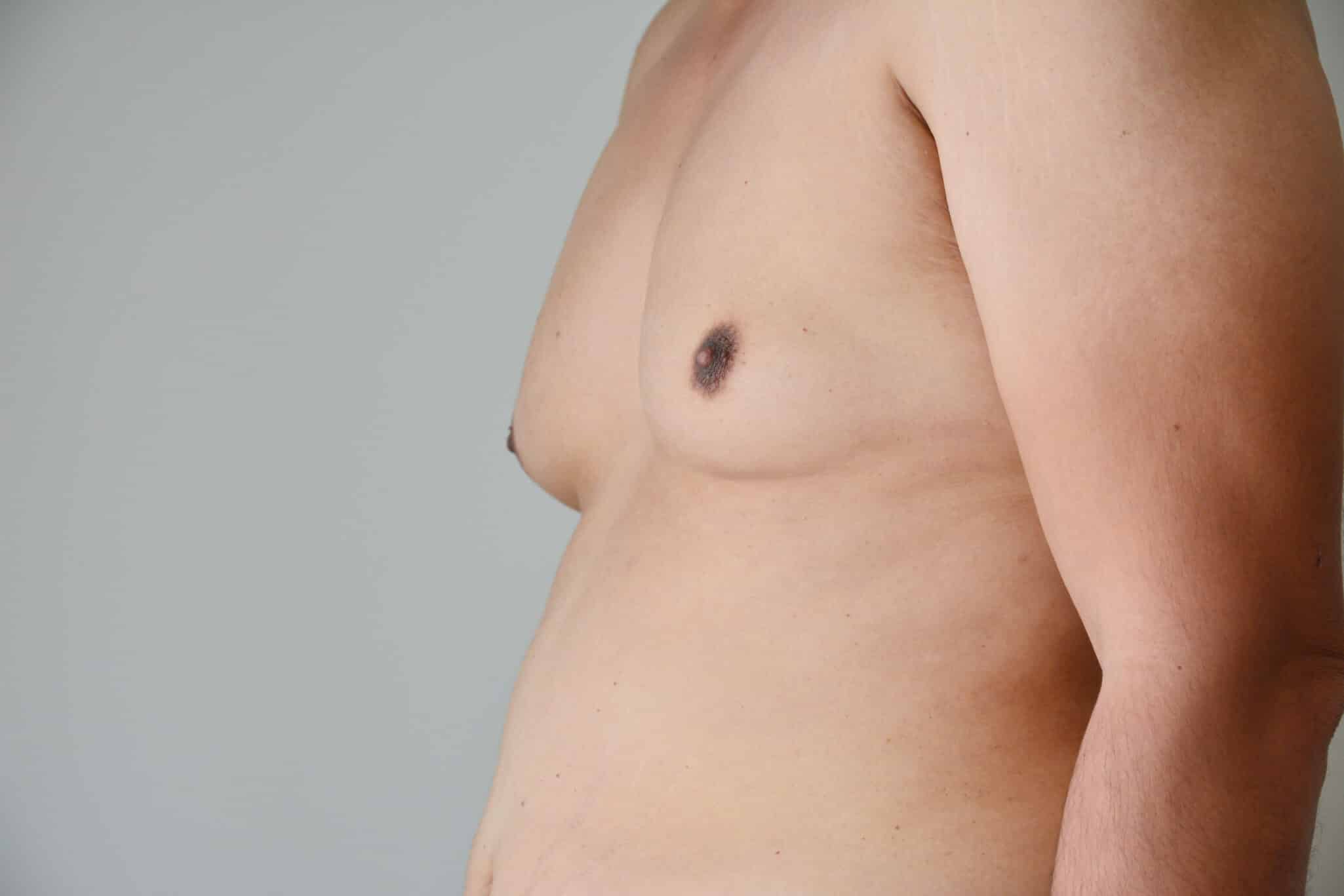 close up men boob fat man male breast reduction Miami FL