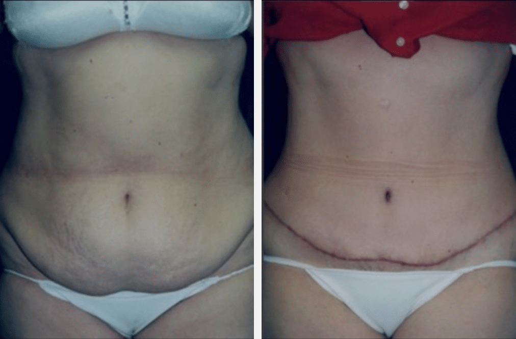 Tummy Tuck (Abdominoplasty) Before & After