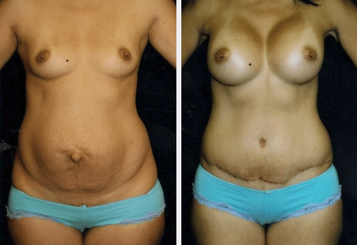 Screen Shot 2019-05-09 at 9.26.30 AM before and after Body Sculpting treatment Miami FL