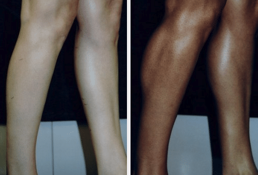Screen Shot 2019-05-09 at 9.46.08 AM before and after Body Contouring Treatment Miami FL