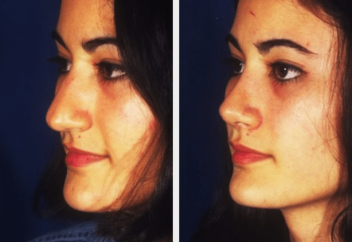 A beofre and after image set of a woman that underwent Rhinoplaty