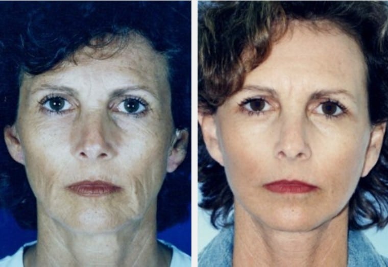 facelift case 2 before & after image of facelift Surgery miami FL