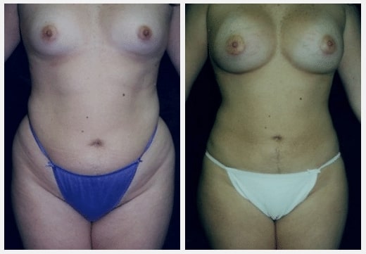 Liposuction-before-after- before & after image of liposuction miami FL