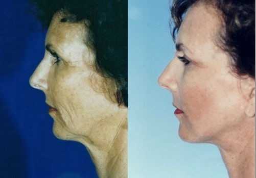 Screen-Shot-2018-10-23-at-4.09.31-PM before and after Facial Cosmetic Surgery Miami FL