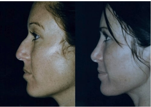 Screen-Shot-2018-10-23-at-4.18.52-PM before and after Facial Cosmetic Treatment Miami FL