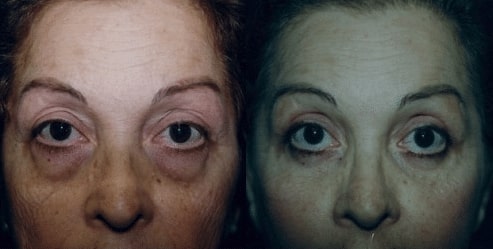 Screen-Shot-2018-10-23-at-4.30.27-PM before and after Facial Cosmetic Procedure Miami FL