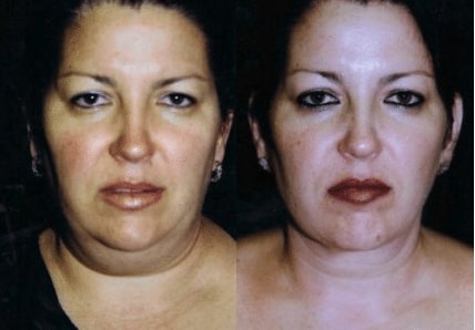 Screen-Shot-2018-12-20-at-9.00.04-AM before & after image of neck liposuction surgery Miami FL