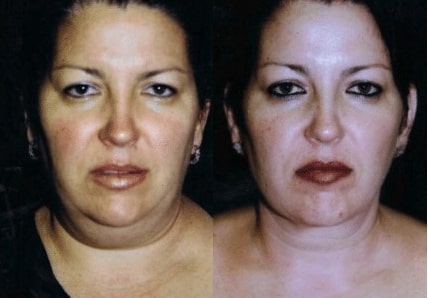 Female patient before and after neck liposuction procedure, less neck fat after procedure