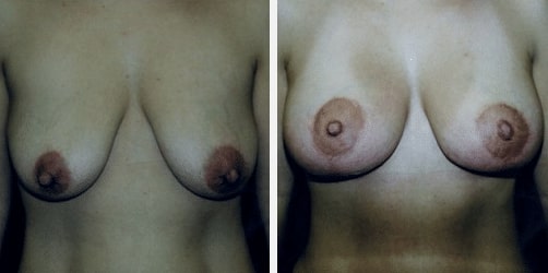 Screen-Shot-2019-10-29-at-8.15.28-AM-1 before and after Cosmetic Breast Surgery Miami FL
