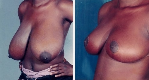 Screen-Shot-2019-10-29-at-8.16.08-AM before and after Breast Surgery Miami FL