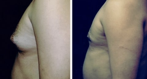 Screen-Shot-2019-10-29-at-8.16.39-AM before and after Breast Surgery treatment Miami FL