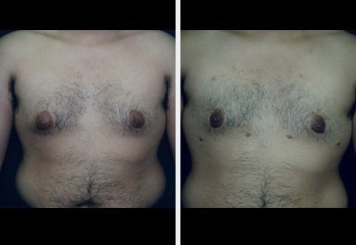 Screen-Shot-2019-12-05-at-10.11.49-AM before & after image of Gynecomastia miami FL
