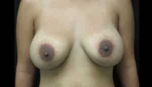 XL Breast Augmentation