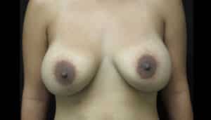 Breast Augmentation – Case 12