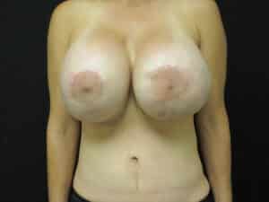 Before Image: XL Breast Augmentation