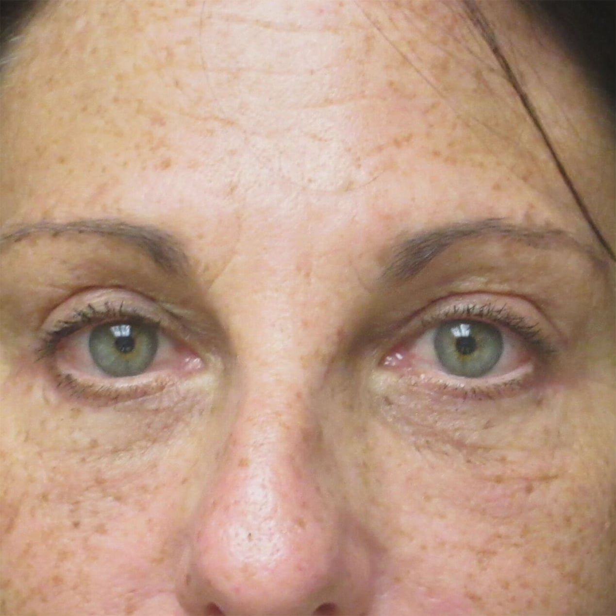 After Image: Blepharoplasty - front