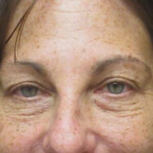 Before Image: Blepharoplasty