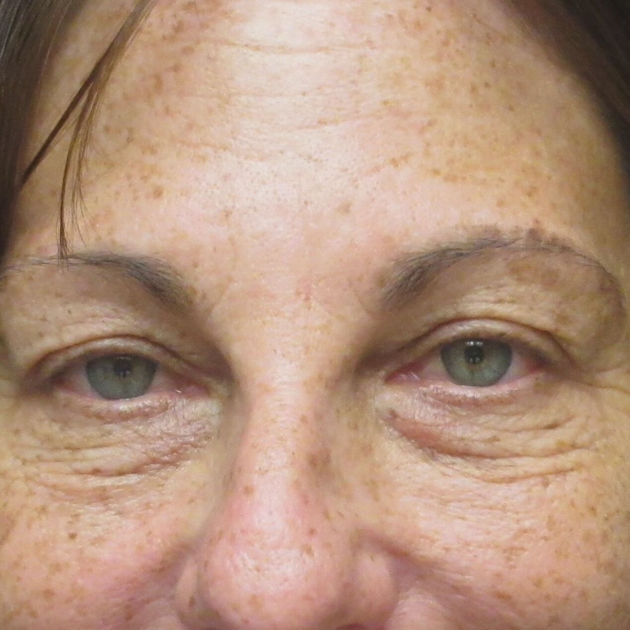 Before Image: Blepharoplasty - front