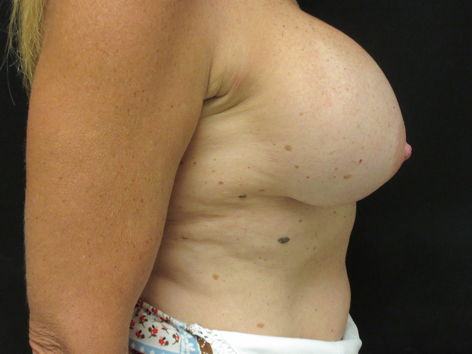 After Image: Breast Augmentation - right-side