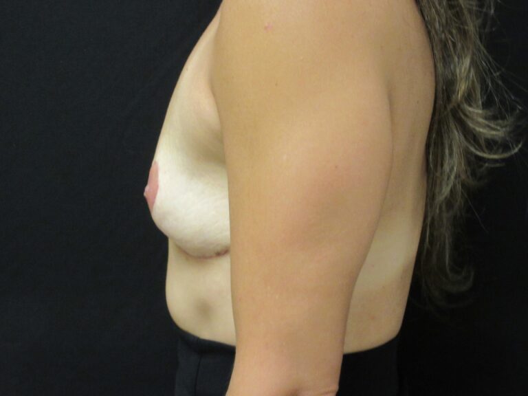 After Image: Breast Implant Removal & Lift - left-side