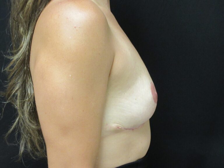 After Image: Breast Implant Removal & Lift - right-side