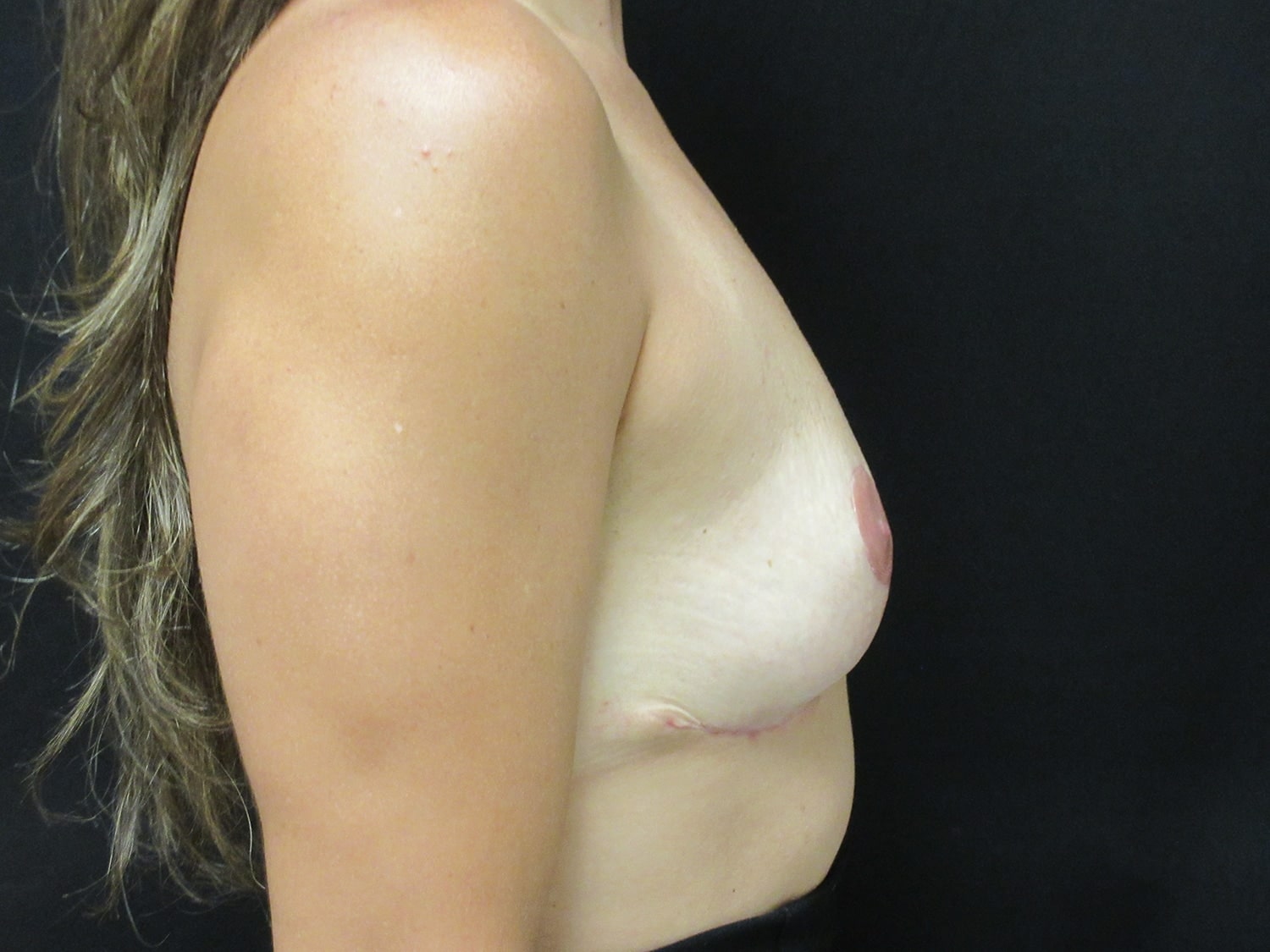 After Image: Breast Implant Removal & Lift - right-side