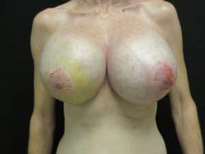 After Image: XL Breast Augmentation