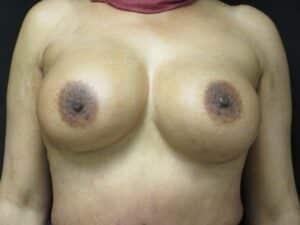 After Image: Breast Augmentation