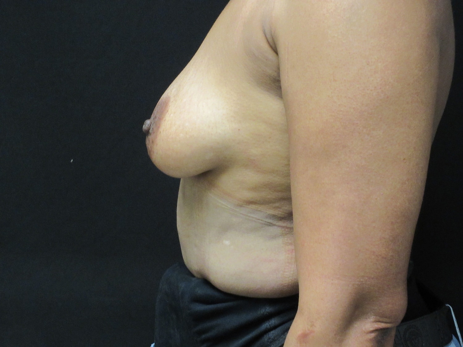 Before Image: Breast Augmentation - left-side