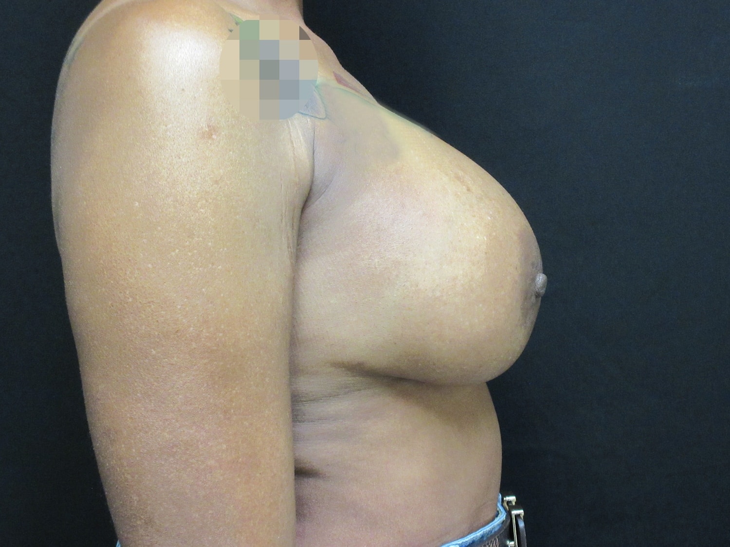 After Image: Breast Augmentation - right-side