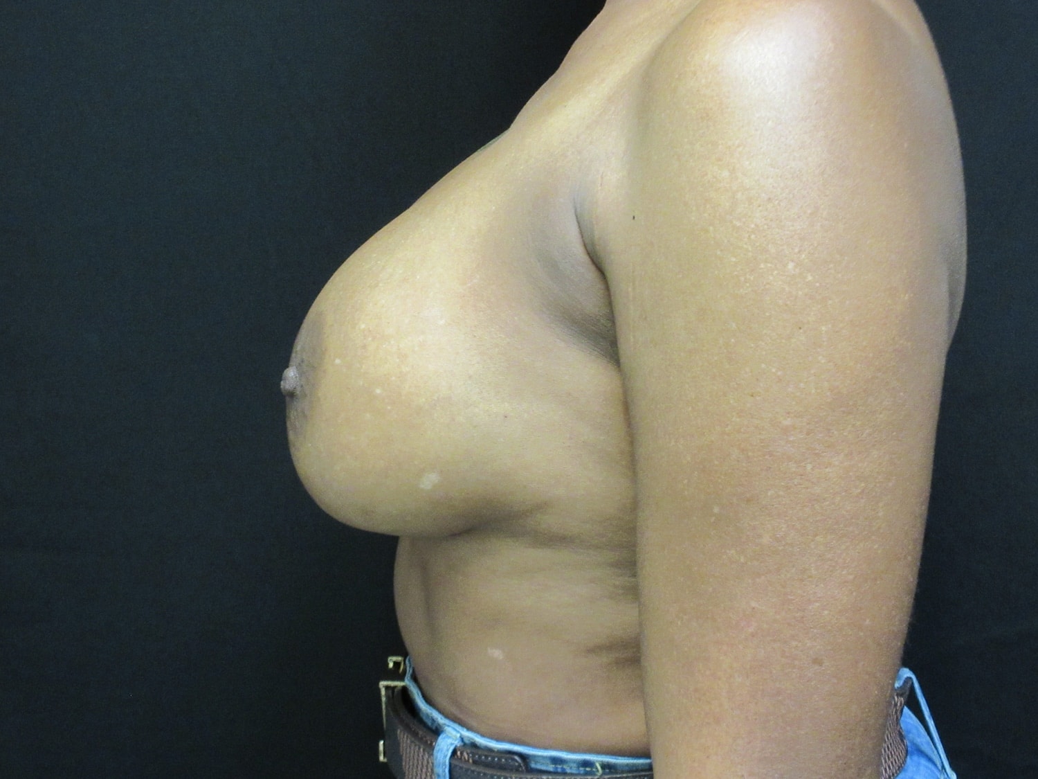 After Image: Breast Augmentation - left-side