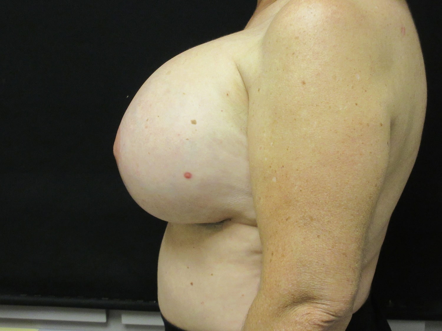 After Image: XL Breast Augmentation - left-side