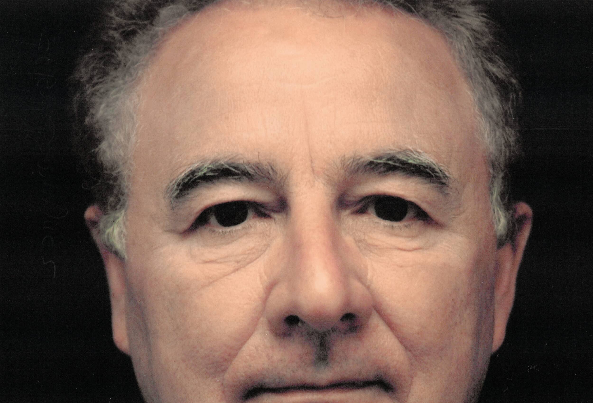 Before Image: Male Blepharoplasty - front
