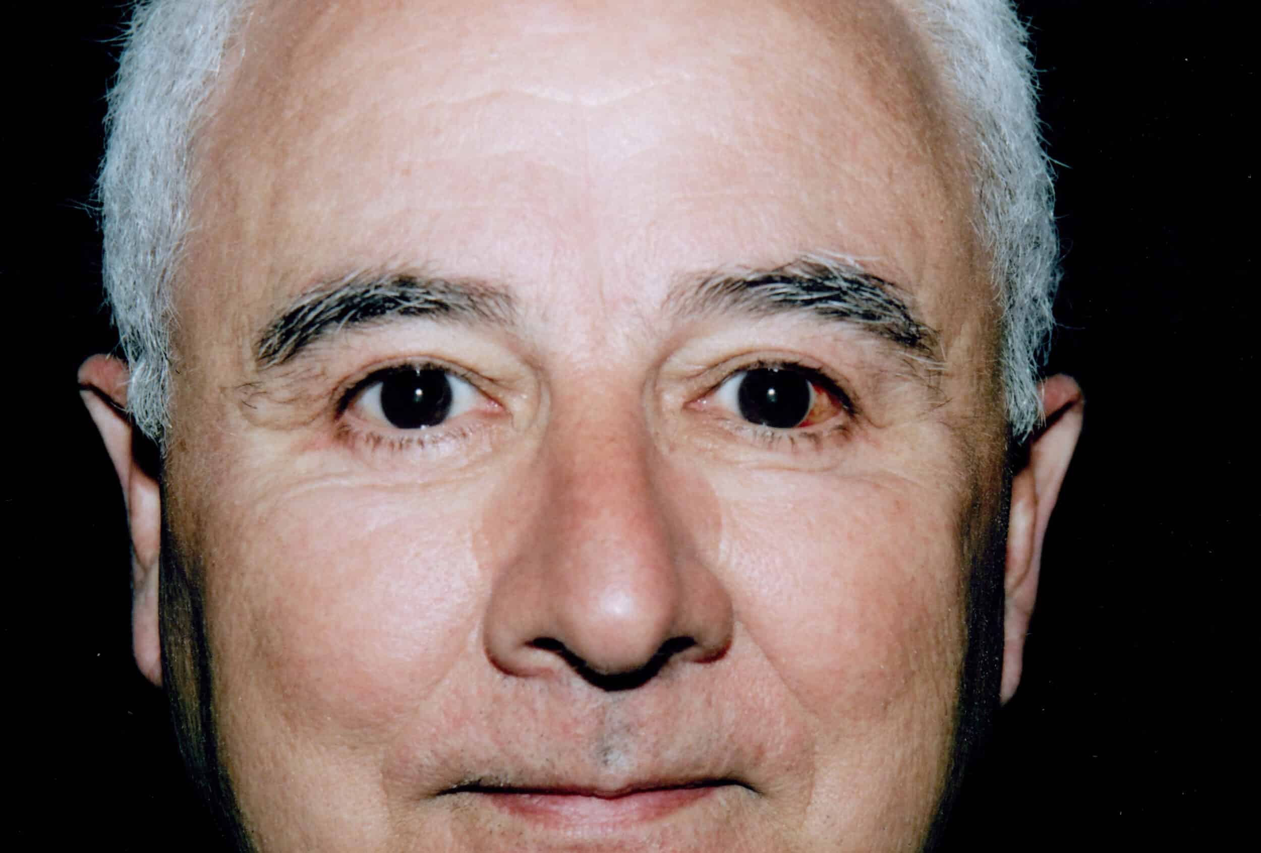 After Image: Male Blepharoplasty - front