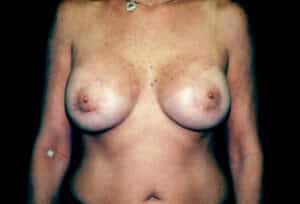 After Image: Breast Augmentation with Circumareolar (Benelli) Lift