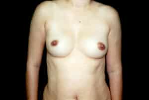 Before Image: Breast Augmentation
