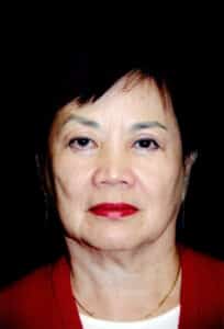 Before Image: Face/Neck Lift