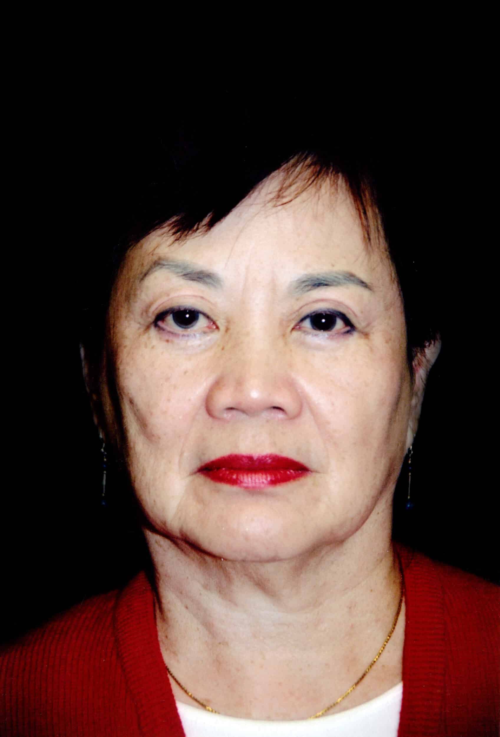 Before Image: Face/Neck Lift - front