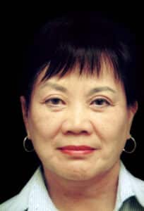 After Image: Face/Neck Lift