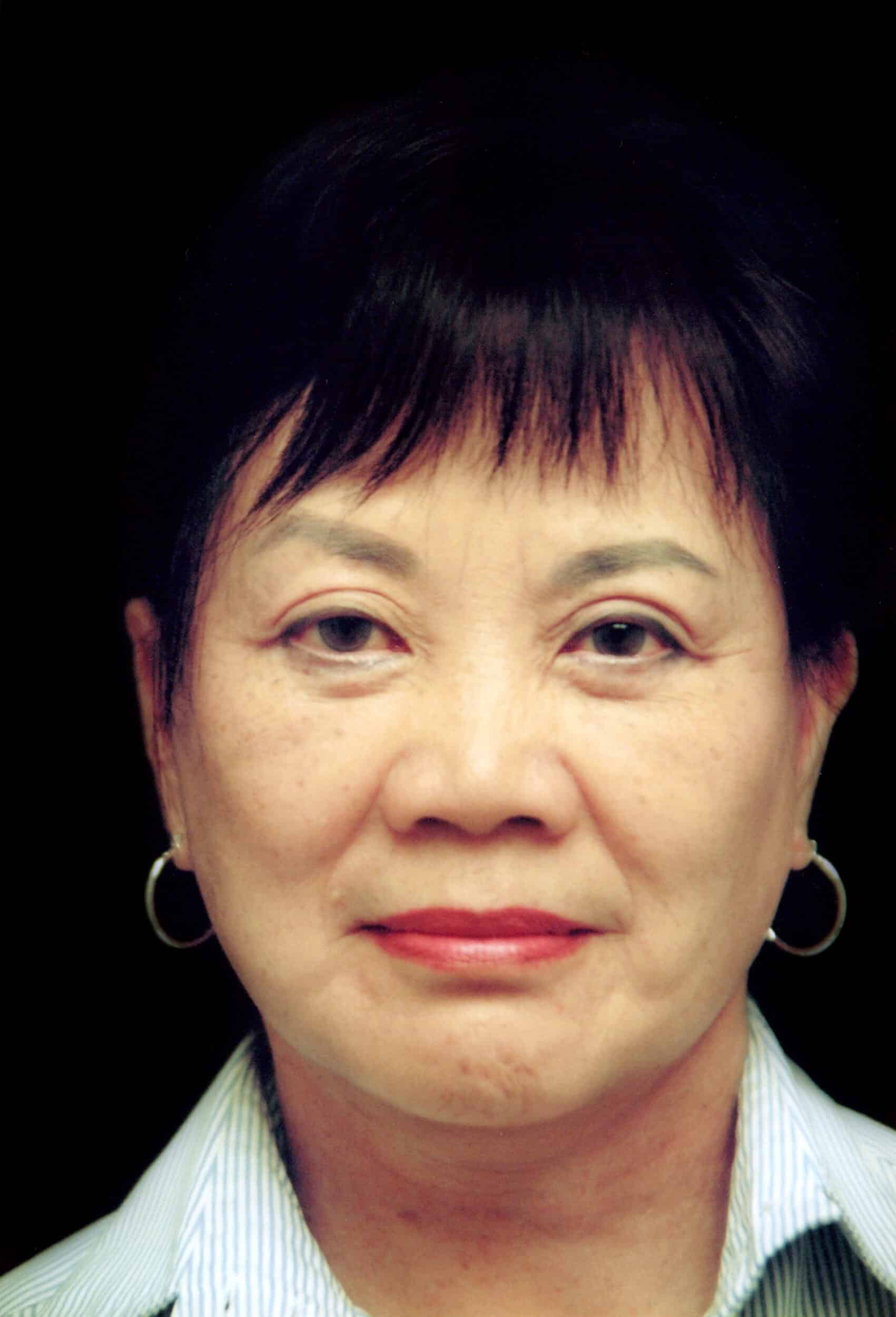 After Image: Face/Neck Lift - front