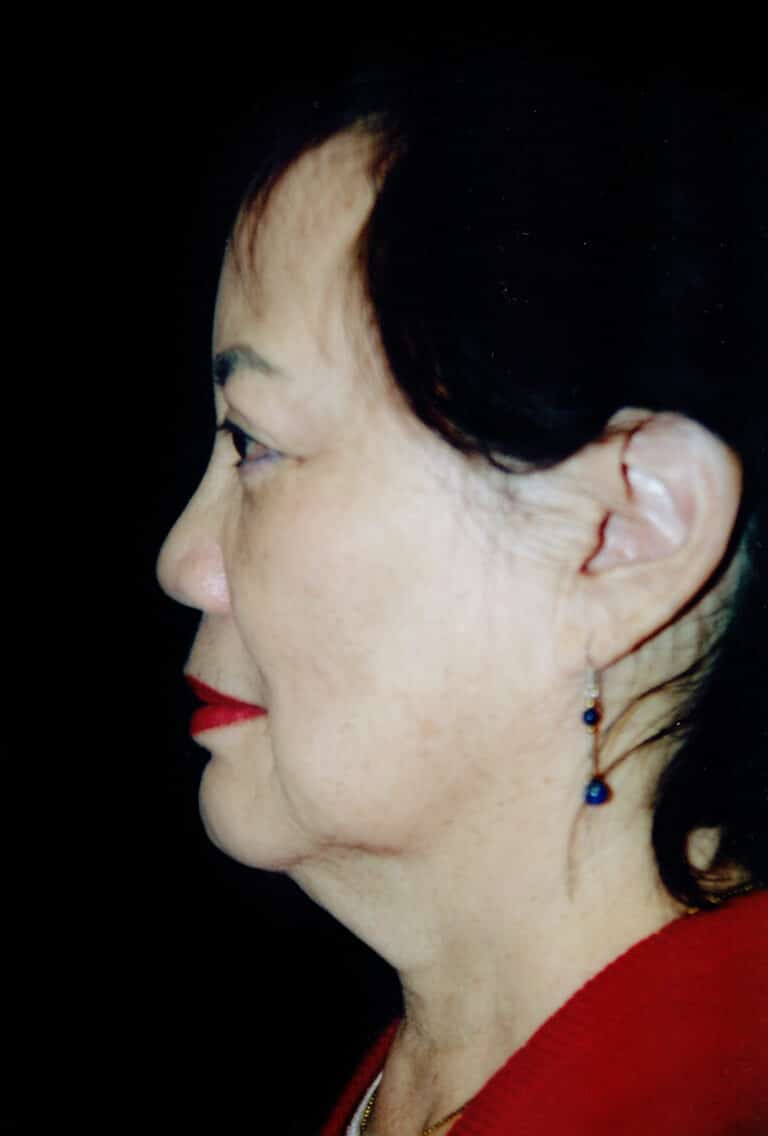 Before Image: Face/Neck Lift - left-side