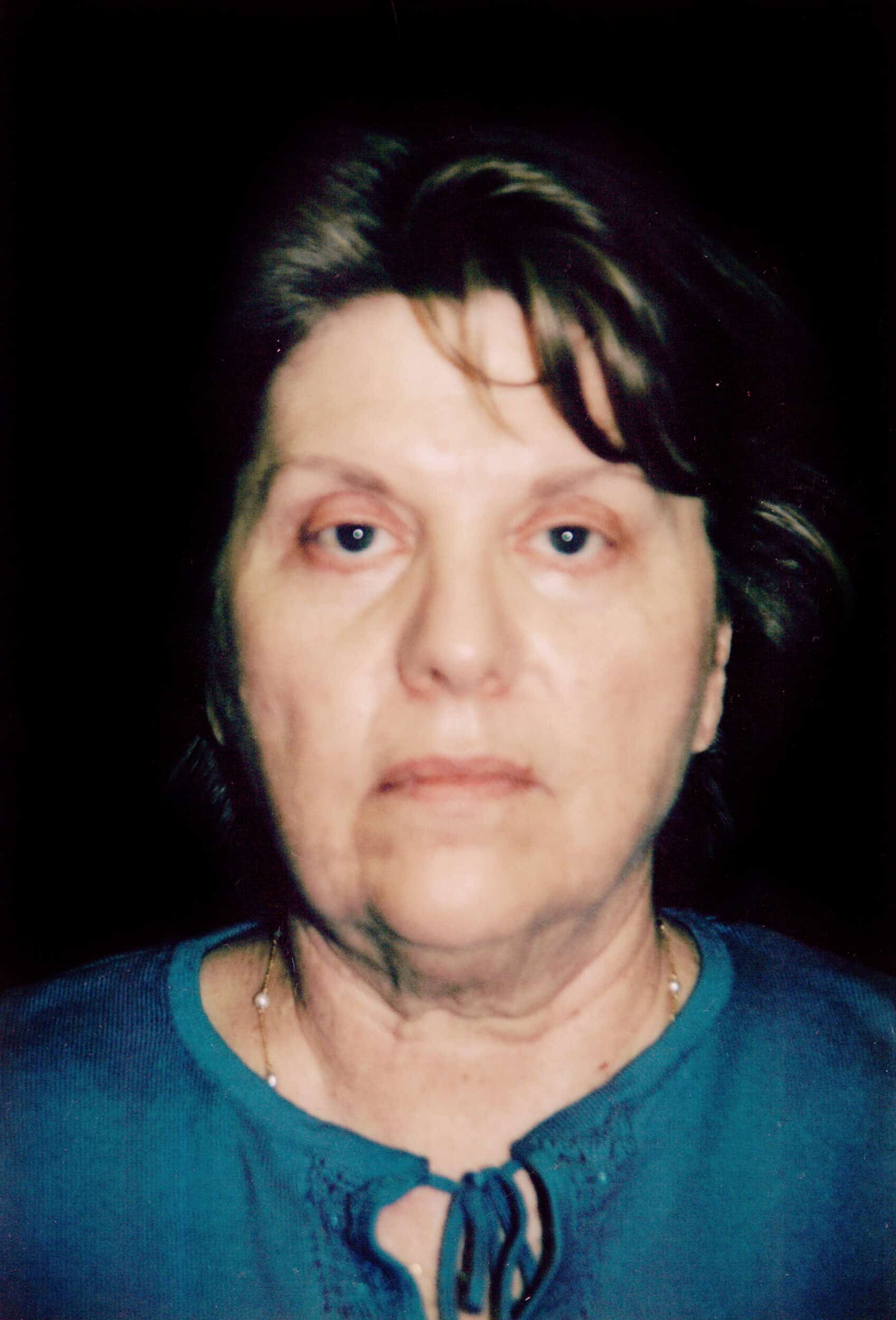 Before Image: Face/Neck Lift - front