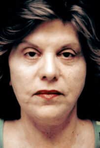 After Image: Face/Neck Lift