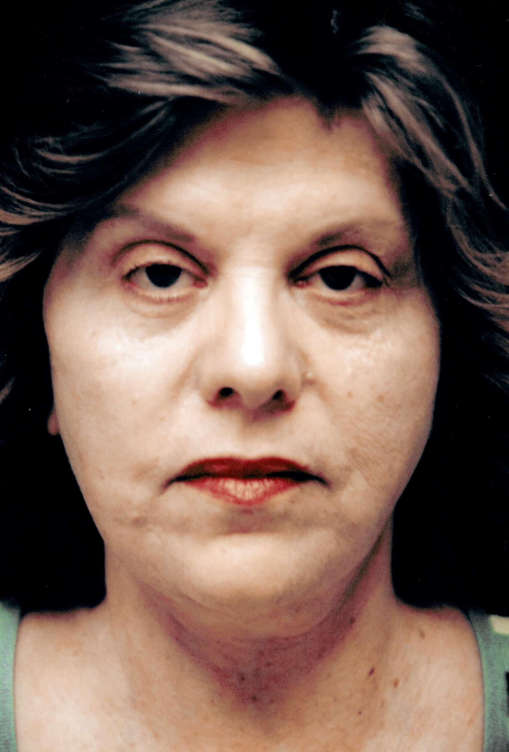 After Image: Face/Neck Lift - front
