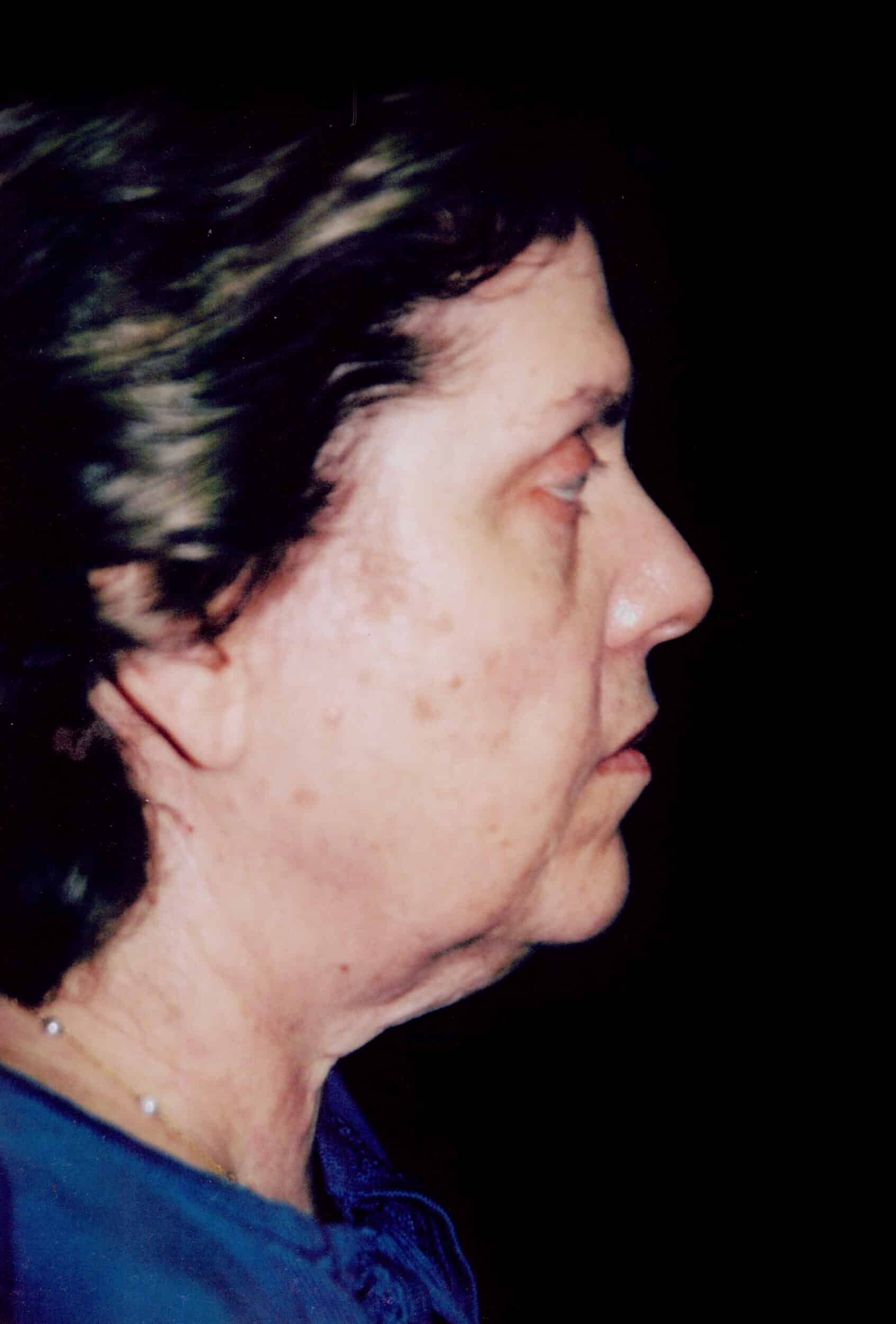 Before Image: Face/Neck Lift - right-side